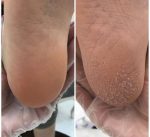 اسپری ترک و پینه پا راکو ویتامینه و لایه بردار - Image 2