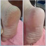اسپری ترک و پینه پا راکو ویتامینه و لایه بردار - Image 4