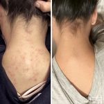 پکیج اورژانسی درمان جوش(صورت و بدن) - Image 2